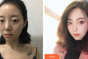 陜西電子409醫(yī)院整形外科張曄整形價(jià)格表附切開(kāi)雙眼皮案例展示