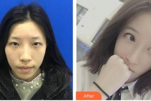 陜西省友誼醫(yī)院醫(yī)學(xué)整形科張永整形價(jià)格表附眼部綜合案例展示