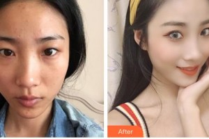 陜西同濟(jì)醫(yī)院激光美容中心武媚整形價(jià)格表附眼部綜合案例展示