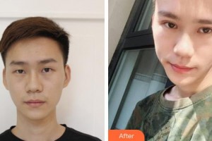 銅川礦務(wù)局中心醫(yī)院燒傷整形科王建軍整形價(jià)格表附切開(kāi)雙眼皮案例展示