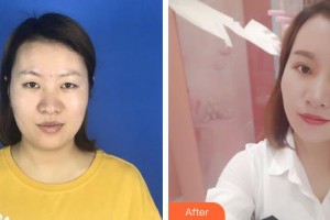 銅川礦務(wù)局中心醫(yī)院燒傷整形科諶煜整形價(jià)格表附切開(kāi)雙眼皮案例展示