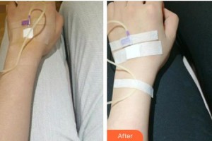 寶雞中心醫(yī)院燒傷整形科習(xí)耀峰整形價格表附美白導(dǎo)入案例展示