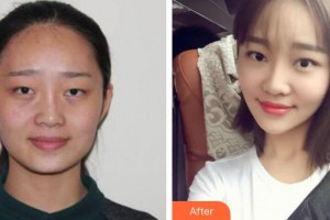 寶雞人民醫(yī)院整形美容科郭建整形價(jià)格表附光子嫩膚案例展示