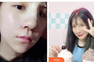 寶雞人民醫(yī)院整形美容科張林宏整形價(jià)格表附清潔祛痘案例展示