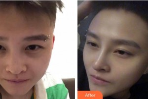 寶雞高新人民醫(yī)院整形美容外科岳能武整形價(jià)格表附紅藍(lán)光祛痘案例展示