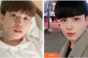 寶雞韓美醫(yī)療美容門(mén)診部林大植 整形價(jià)格表附去痘印痘坑案例展示