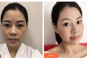 寶雞高新人民醫(yī)院整形美容外科景海鵬整形價格表附眼部綜合案例展示