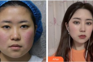 寶雞韓美醫(yī)療美容門(mén)診部李峰濤整形價(jià)格表附眼部綜合案例展示