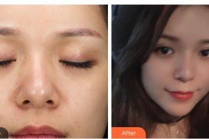 寶雞韓美醫(yī)療美容門診部金修永 整形價格表附眼部綜合案例展示