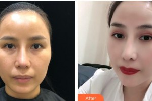 寶雞韓美醫(yī)療美容門診部李元澤 整形價格表附開內(nèi)眼角案例展示