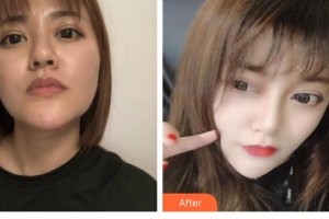 寶雞皮膚病醫(yī)院文東亮整形價格表附硅膠隆鼻案例展示