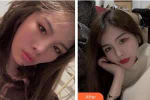 寶雞韓美醫(yī)療美容門診部張曉竹整形價格表附牙貼面案例展示