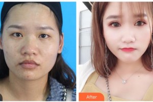 寶雞麗人婦科醫(yī)院醫(yī)療美容科竺湘云整形價(jià)格表附切開(kāi)雙眼皮案例展示