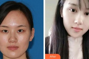 寶雞愛爾眼科醫(yī)院南銀娟整形價格表附眼部綜合案例展示