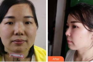 寶雞高新人民醫(yī)院整形美容外科呂成整形價格表附眼部綜合案例展示