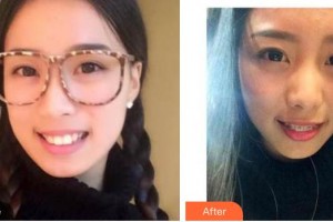 寶雞市口腔醫(yī)院趙芳萍整形價格表附金屬托槽矯正案例展示