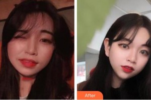 寶雞市口腔醫(yī)院景拴讓整形價格表附牙齒隱形矯正案例展示