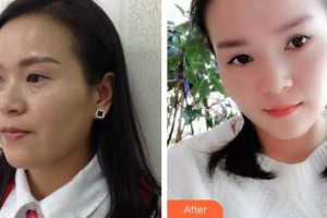 寶雞中心醫(yī)院燒傷整形科王云俠整形價格表附內(nèi)切祛眼袋案例展示