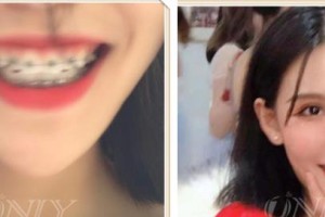 寶雞市口腔醫(yī)院曹蓓整形價格表附牙貼面案例展示