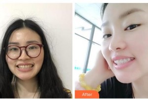 寶雞市口腔醫(yī)院高惠英整形價格表附金屬托槽矯正案例展示