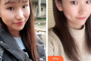 寶雞市口腔醫(yī)院逯明整形價(jià)格表附牙貼面案例展示