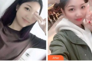 寶雞市口腔醫(yī)院湯臘梅整形價(jià)格表附根管調(diào)節(jié)案例展示