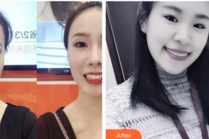 寶雞市口腔醫(yī)院張志成整形價(jià)格表附牙齒隱形矯正案例展示