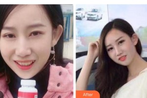 寶雞市口腔醫(yī)院賈懷斌整形價(jià)格表附牙齒隱形矯正案例展示