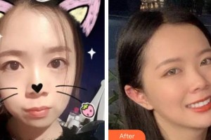 寶雞市口腔醫(yī)院董海文整形價(jià)格表附金屬托槽矯正案例展示