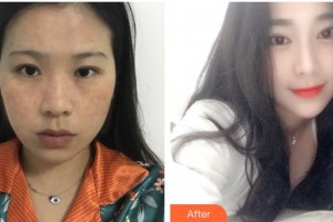 貴州省第二人民醫(yī)院整形外科左路整形價(jià)格表附激光祛斑案例展示