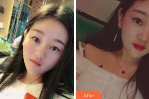 貴州省人民醫(yī)院整形美容燒傷顯微外科郭曉波整形價(jià)格表附微針?biāo)獍咐故?>
</a>
<h3 class=