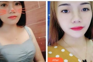 貴州省人民醫(yī)院整形美容燒傷顯微外科趙桂香整形價(jià)格表附激光祛斑案例展示