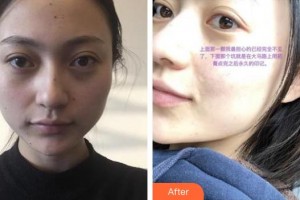 貴州省紅十字會(huì)婦女兒童醫(yī)院整形美容中心曾寧川整形價(jià)格表附激光點(diǎn)痣案例展示