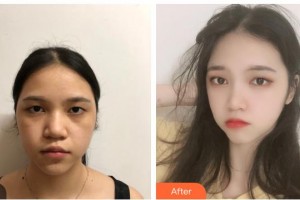 貴州整形美容外科醫(yī)院王家順整形價(jià)格表附牙貼面案例展示