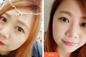 貴州晶朗眼科醫(yī)院喬薇整形價(jià)格表附眶隔脂肪釋放案例展示