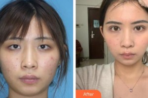 貴州晶朗眼科醫(yī)院楊安昌整形價格表附眼部綜合案例展示