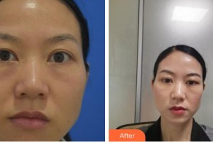 貴州晶朗眼科醫(yī)院姚曉明整形價格表附眼部修復(fù)案例展示