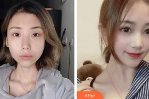 貴州普瑞眼科醫(yī)院李志敏整形價格表附眼部綜合案例展示