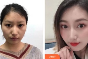 貴州普瑞眼科醫(yī)院張唯偉整形價格表附眼部綜合案例展示