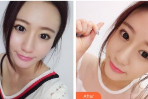 貴陽愛爾眼科醫(yī)院劉誠整形價(jià)格表附眼部修復(fù)案例展示