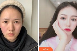 貴陽愛爾眼科醫(yī)院孫儀亞整形價格表附眼部綜合案例展示