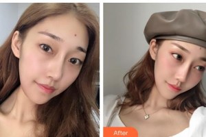 貴陽愛爾眼科醫(yī)院胡大立整形價格表附眼部綜合案例展示