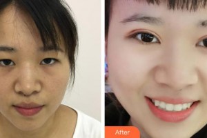 貴陽愛爾眼科醫(yī)院陳國榮整形價格表附定點雙眼皮案例展示