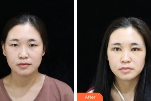 貴陽愛爾眼科醫(yī)院劉忠華整形價(jià)格表附眼部綜合案例展示