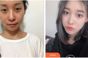 貴陽愛爾眼科醫(yī)院廖進(jìn)軍整形價格表附切開雙眼皮案例展示