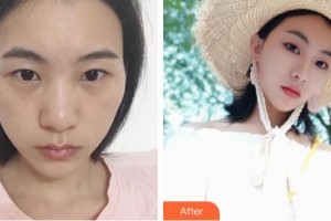 貴陽愛爾眼科醫(yī)院鐘燕整形價格表附眼部綜合案例展示