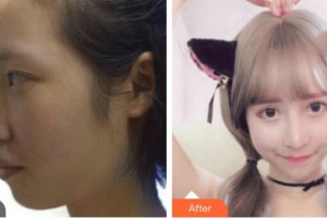 貴陽愛爾眼科醫(yī)院陳筑惠整形價(jià)格表附切開雙眼皮案例展示