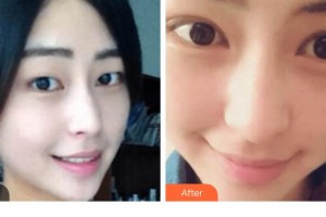 貴陽愛爾眼科醫(yī)院陳曉玲整形價格表附切開雙眼皮案例展示