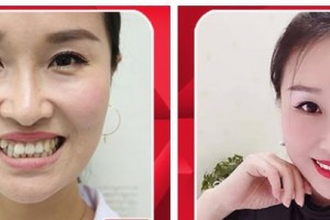 遵義利美康整形美容醫(yī)院史躍興整形價格表附隱形托槽矯正案例展示