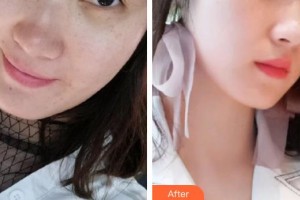 遵義利美康整形美容醫(yī)院羅美媛住院醫(yī)師整形價格表附激光祛斑案例展示